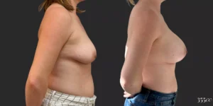 Breast Augmentation #68, before and after photo, view 3