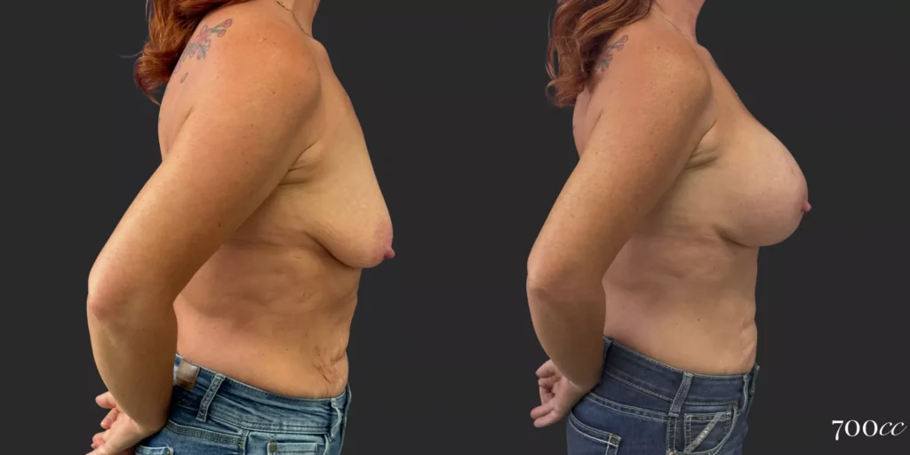 Breast Augmentation #69, before and after photo, view 3