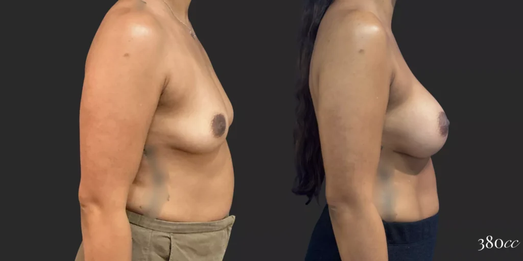 Breast Augmentation #70, before and after photo, view 3