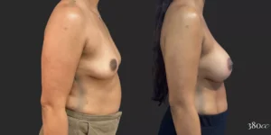 Breast Augmentation #70, before and after photo, view 3