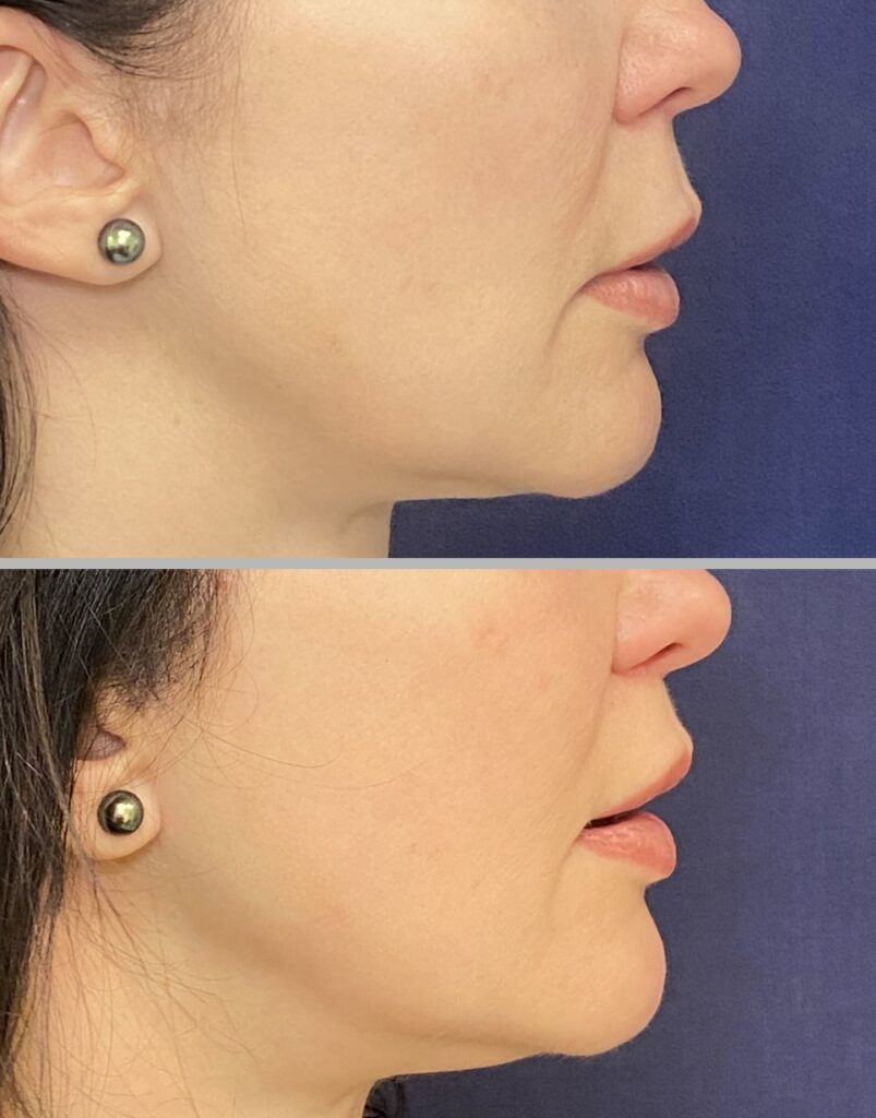 Lip Lift #003, before and after photo, view 5