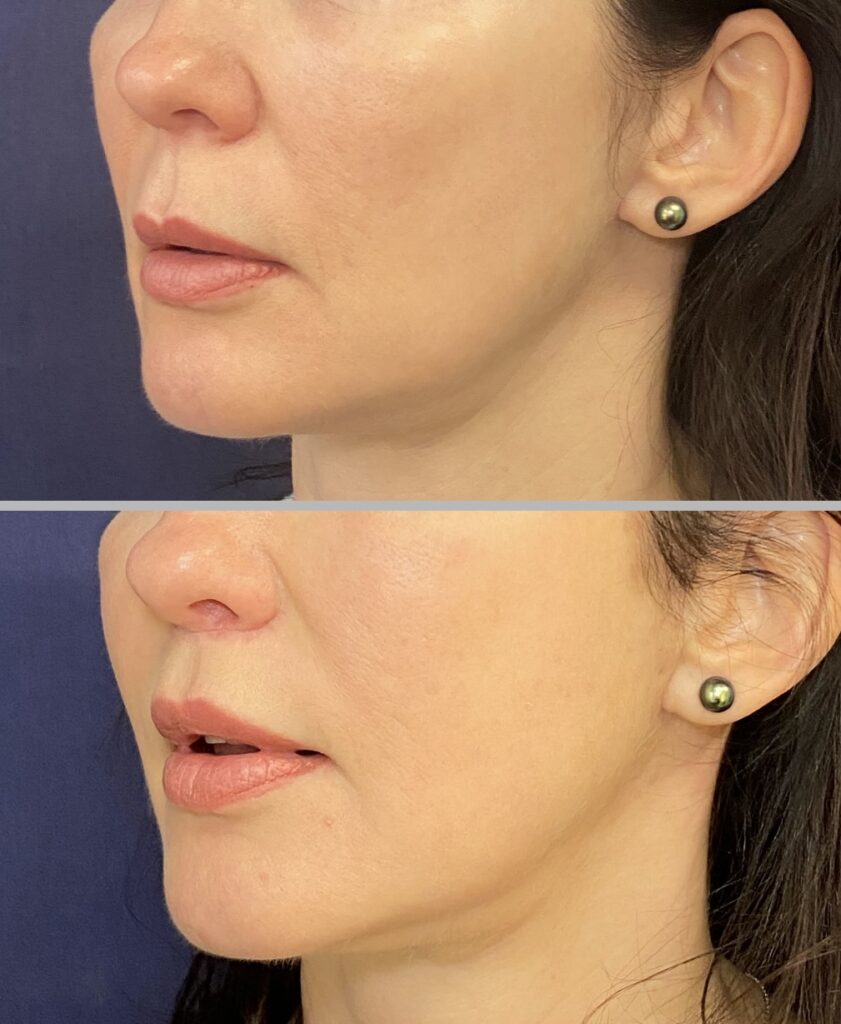 Lip Lift #003, before and after photo, view 4