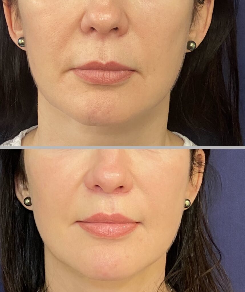 Lip Lift #003, before and after photo, view 2