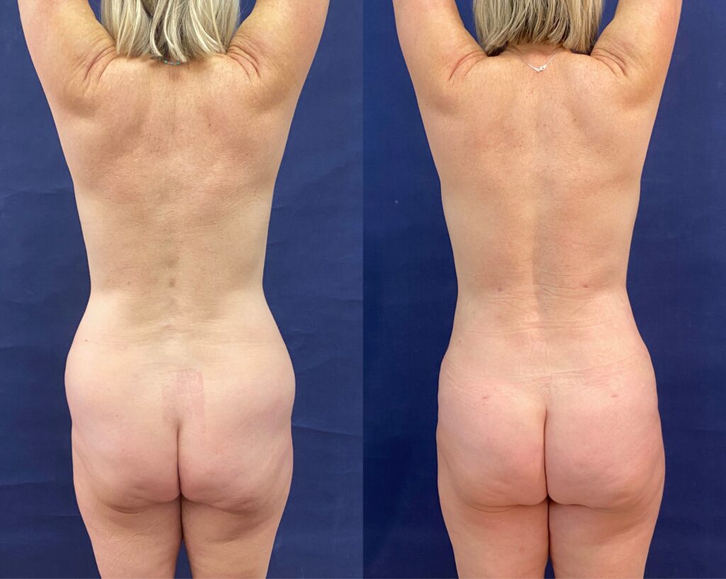 Implant Exchange & Liposuction #24, before and after photo, view 3