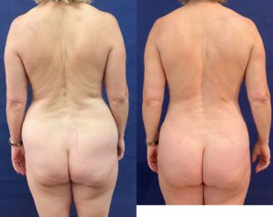 Implant Exchange & Liposuction #24, before and after photo, view 6