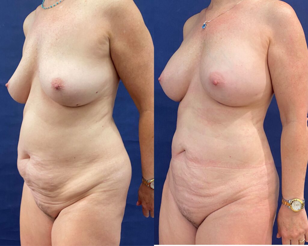 Implant Exchange & Liposuction #24, before and after photo, view 2
