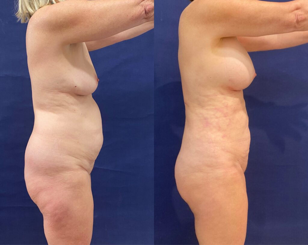 Implant Exchange & Liposuction #24, before and after photo, view 4
