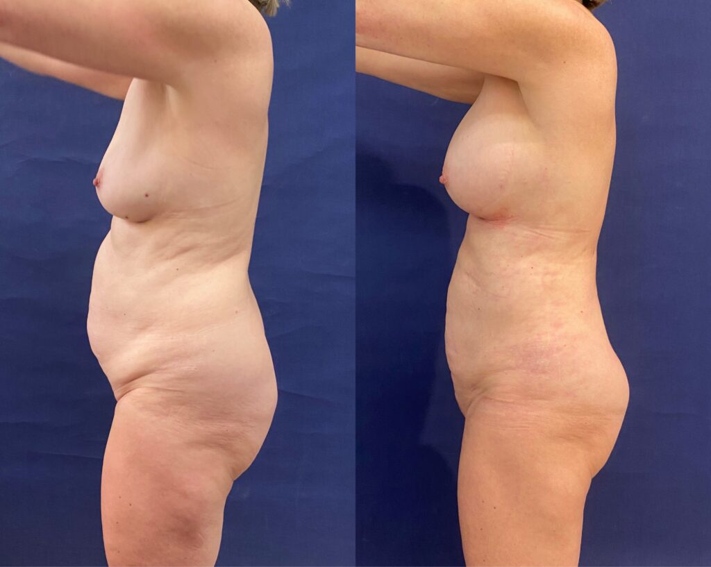 Implant Exchange & Liposuction #24, before and after photo, view 5