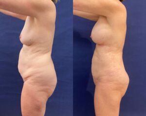 Implant Exchange & Liposuction #24, before and after photo, view 5