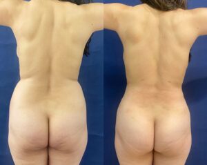 Liposuction #24, before and after photo, view 4