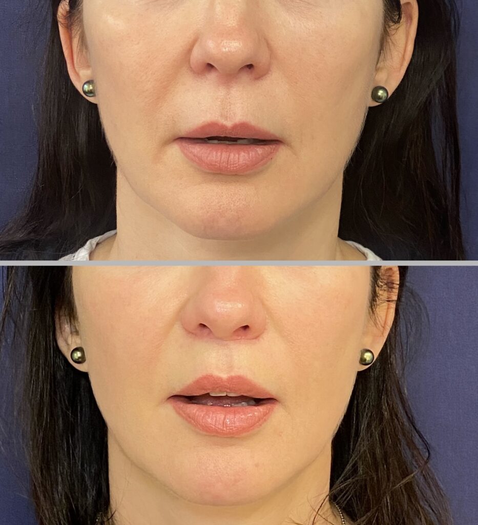 Lip Lift #004, before and after photo, view 3