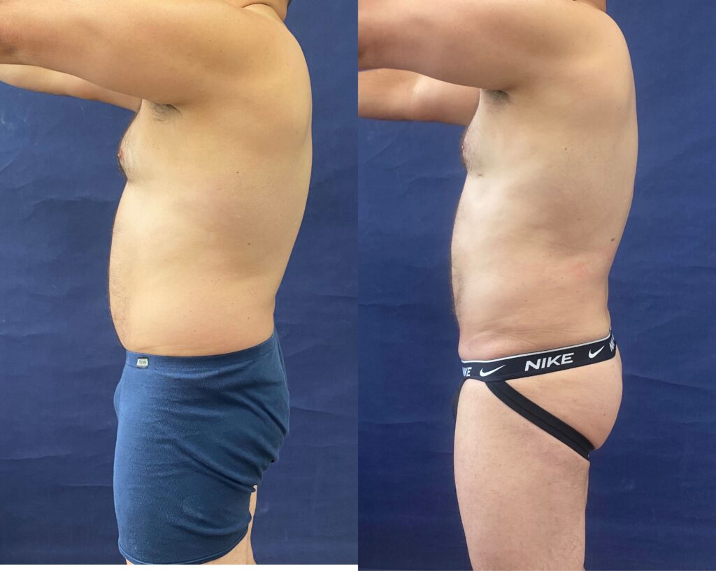 Liposuction #25, before and after photo, view 3