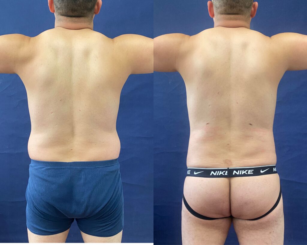 Liposuction #25, before and after photo, view 4