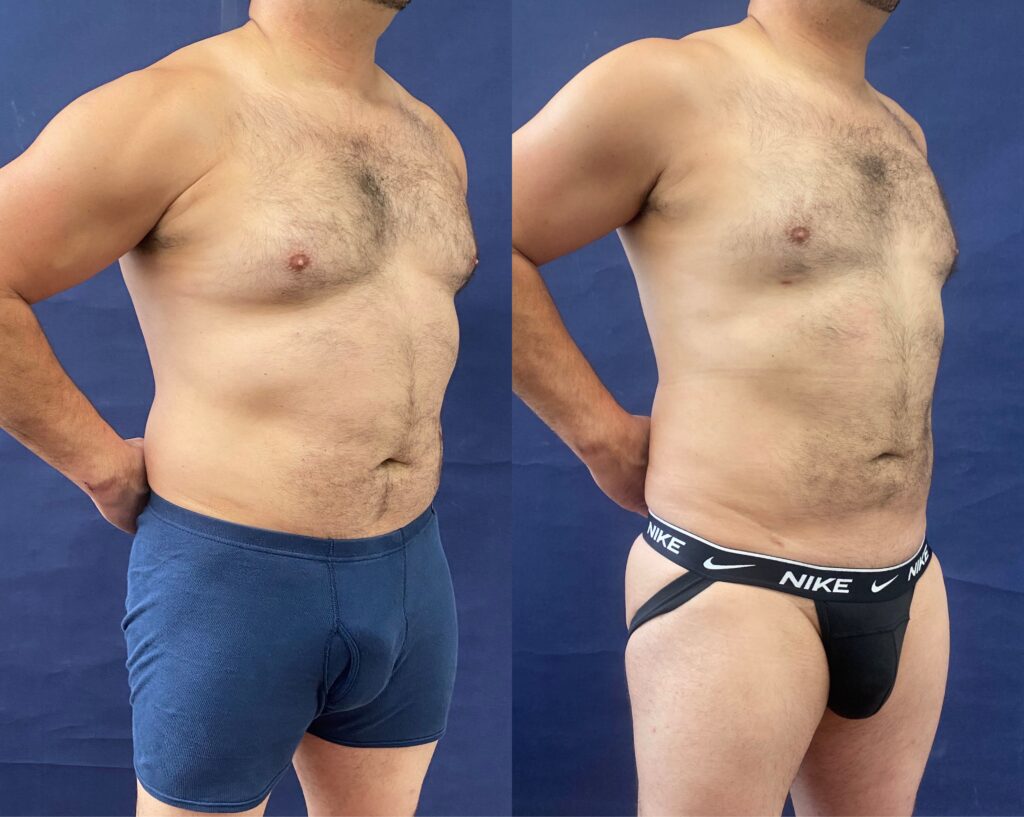 Liposuction #25, before and after photo, view 2