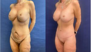 Tummy Tuck #013, before and after photo, view 2