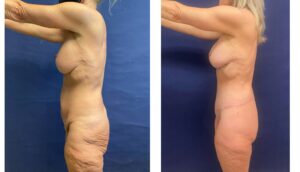 Tummy Tuck #013, before and after photo, view 3