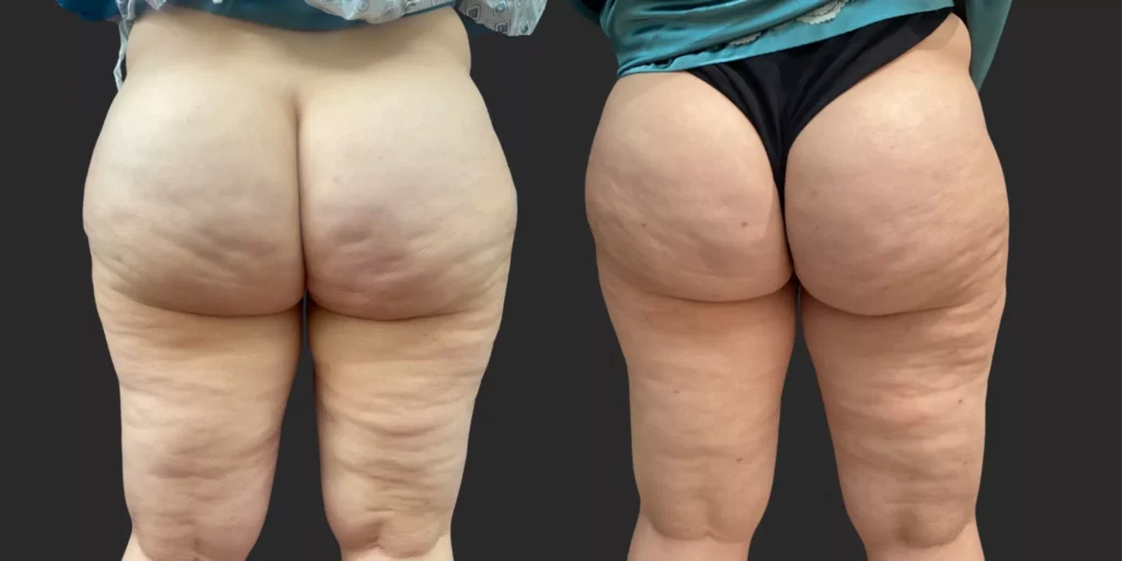 Avéli Cellulite Reduction #003, before and after photo