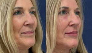 Fillers, before and after photo, view 4