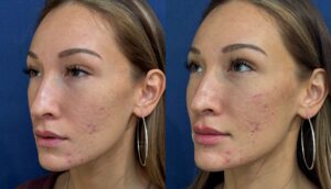 Fillers, before and after photo, view 2