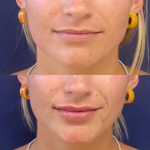 Fillers, before and after photo