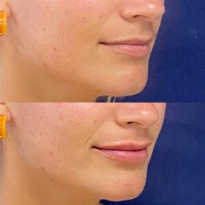 Fillers, before and after photo, view 3