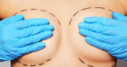 breast implantation