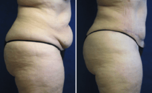 Tummy Tuck #002, before and after photo