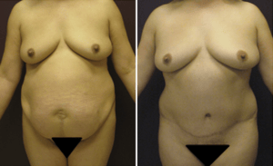 Tummy Tuck #004, before and after photo