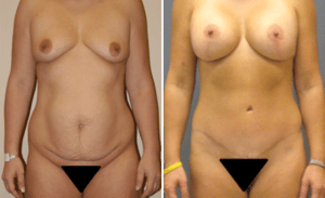 Tummy Tuck #005, before and after photo