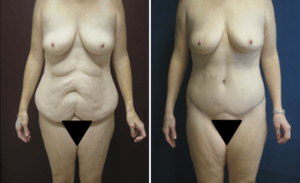 Tummy Tuck #006, before and after photo