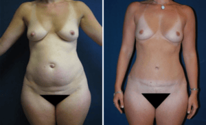 Tummy Tuck #008, before and after photo