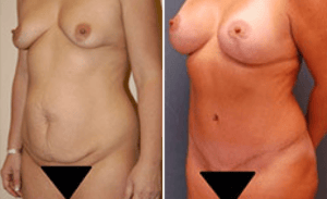 Tummy Tuck #009, before and after photo