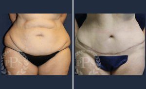 Tummy Tuck #010, before and after photo
