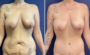 Tummy Tuck #012, before and after photo