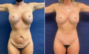 Tummy Tuck #013, before and after photo