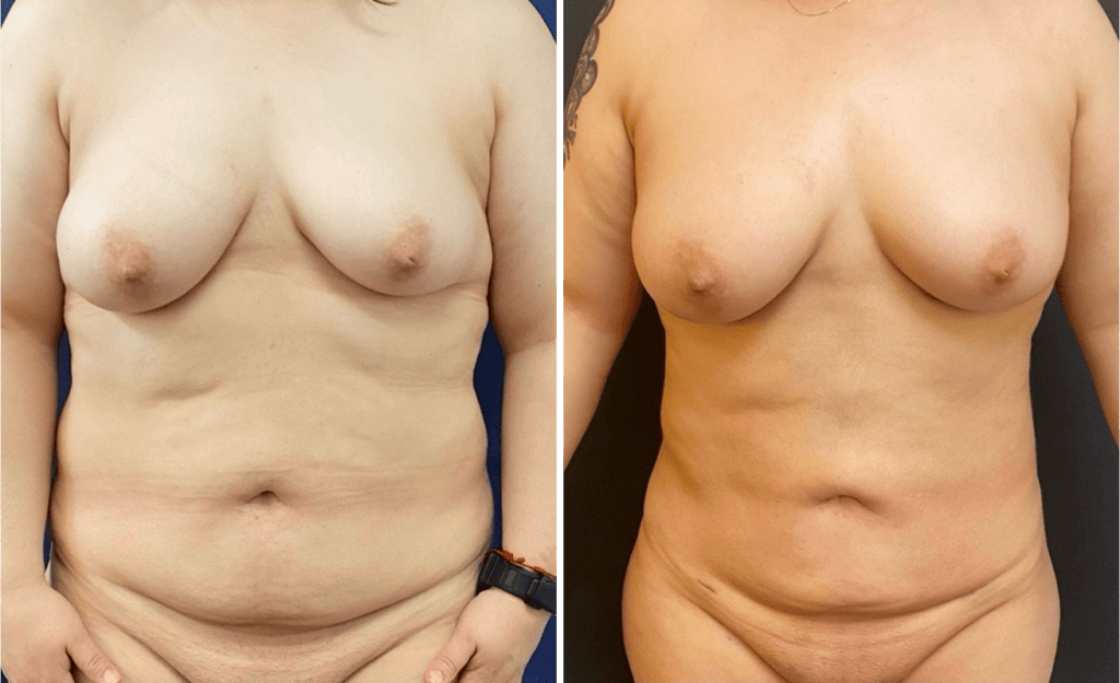 Liposuction #29, before and after photo