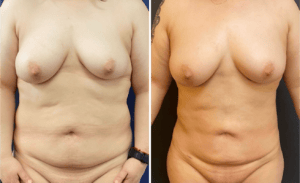 Liposuction #29, before and after photo