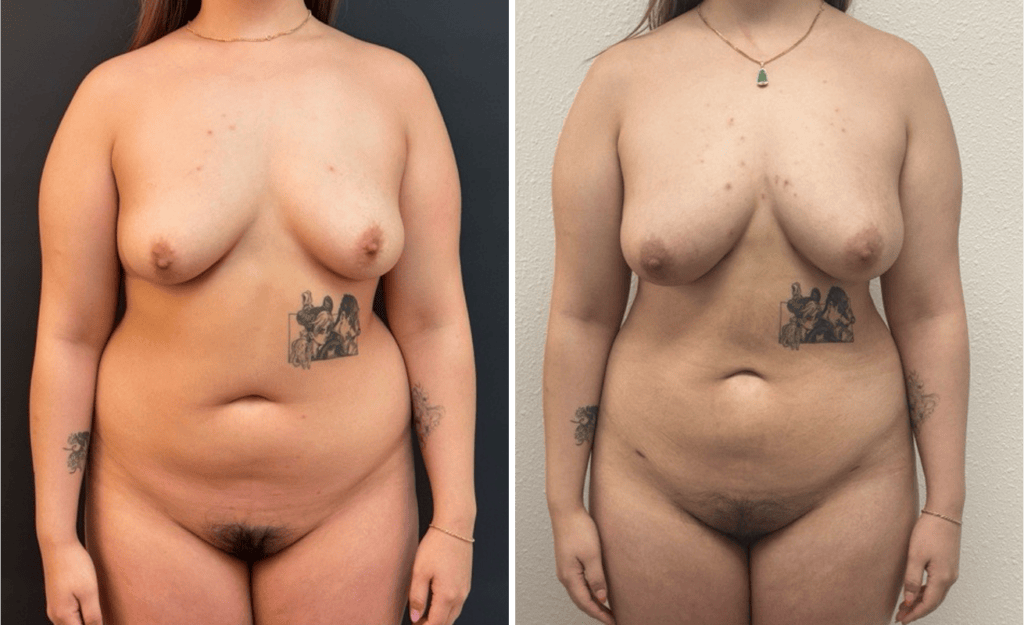 Lipo Breast Augmentation #003, before and after photo