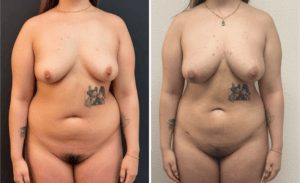 Lipo Breast Augmentation #003, before and after photo
