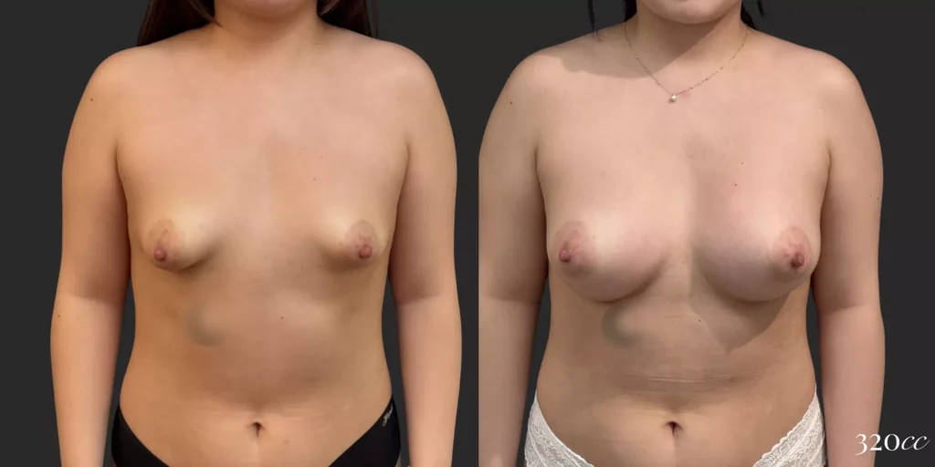 Breast Augmentation #73, before and after photo
