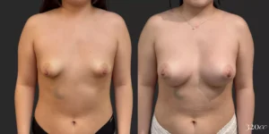 Breast Augmentation #73, before and after photo