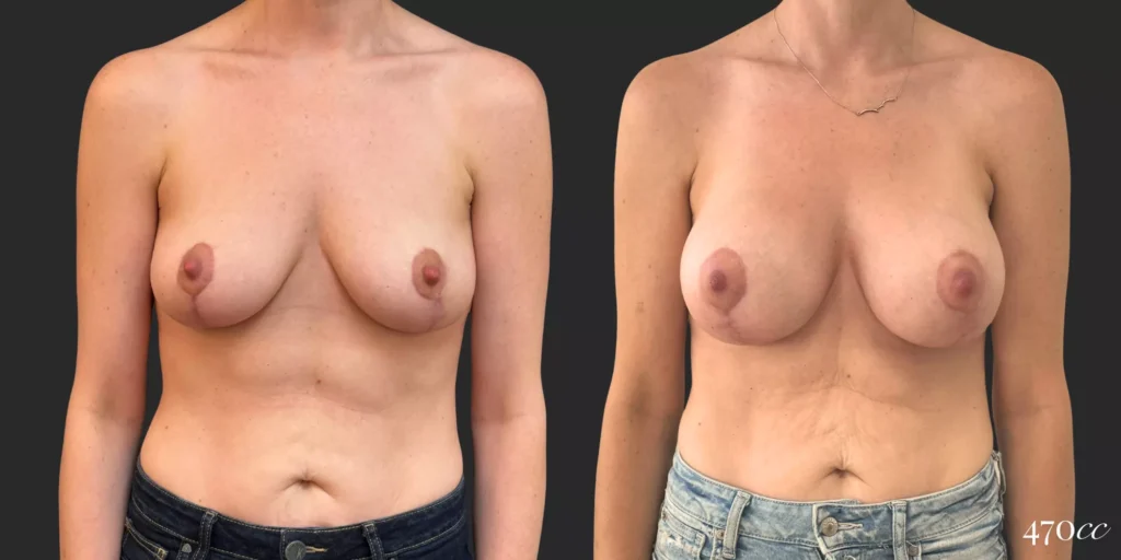Breast Augmentation #74, before and after photo