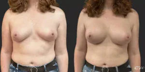 Breast Augmentation #75, before and after photo