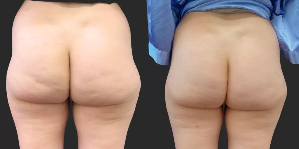 Avéli Cellulite Reduction #004, before and after photo