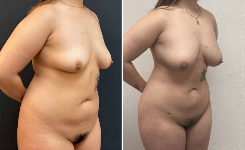 Lipo Breast Augmentation #003, before and after photo, view 2
