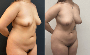 Lipo Breast Augmentation #003, before and after photo, view 2
