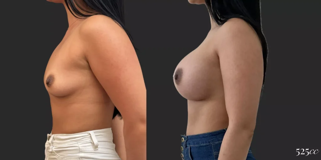 Breast Augmentation #72, before and after photo, view 2
