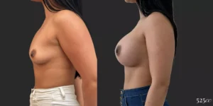 Breast Augmentation #72, before and after photo, view 2