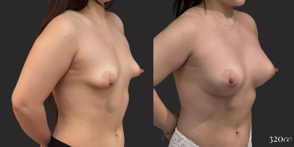 Breast Augmentation #73, before and after photo, view 2