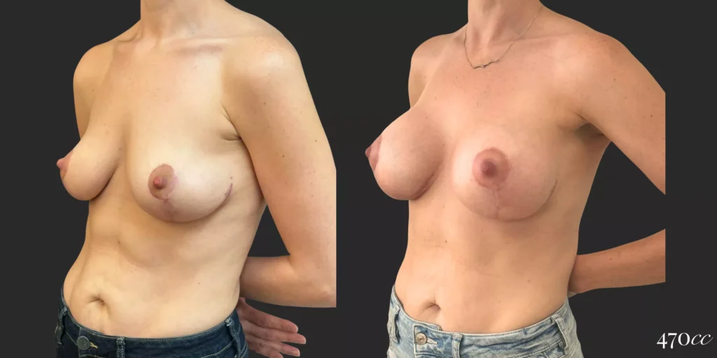 Breast Augmentation #74, before and after photo, view 2